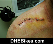 Click on the image for more info and a larger downhill mountain biking injury picture