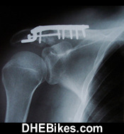 Click on the image for more info and a larger downhill mountain biking injury picture