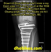 Click on the image for more info and a larger downhill mountain biking injury picture