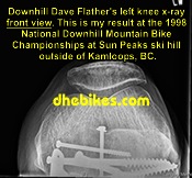Click on the image for more info and a larger downhill mountain biking injury picture